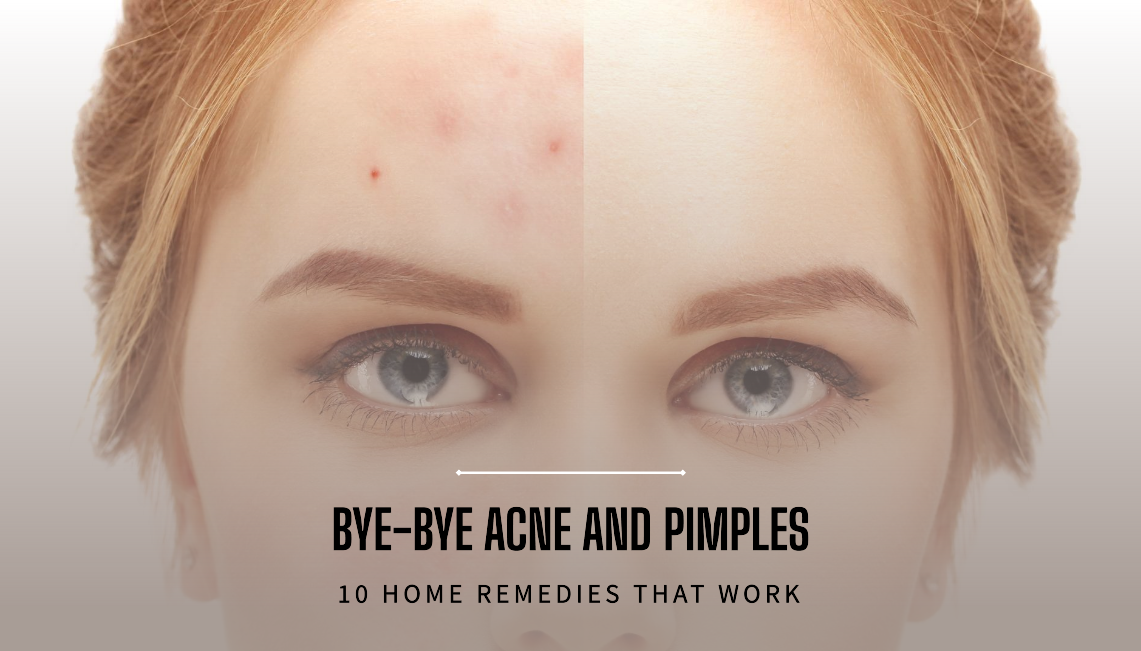 Home Remedies for Acne and Pimples