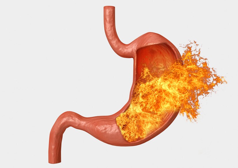 Acid Reflux Home Remedies