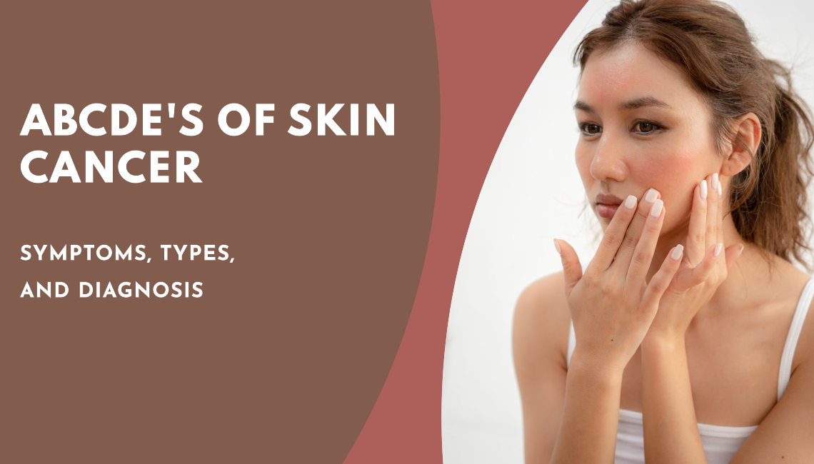 The ABCDEs of Skin Cancer: Symptoms, Types, and Diagnosis