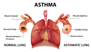 Asthma Awareness