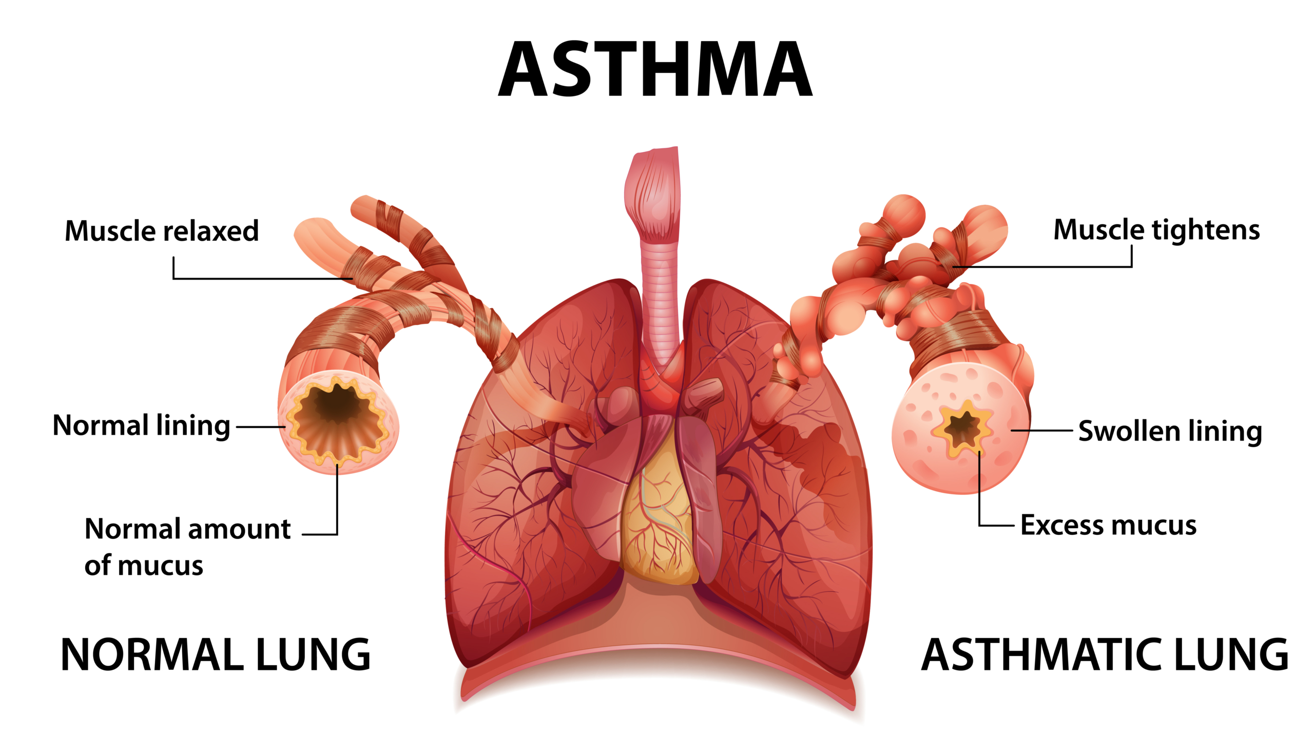 Asthma Awareness