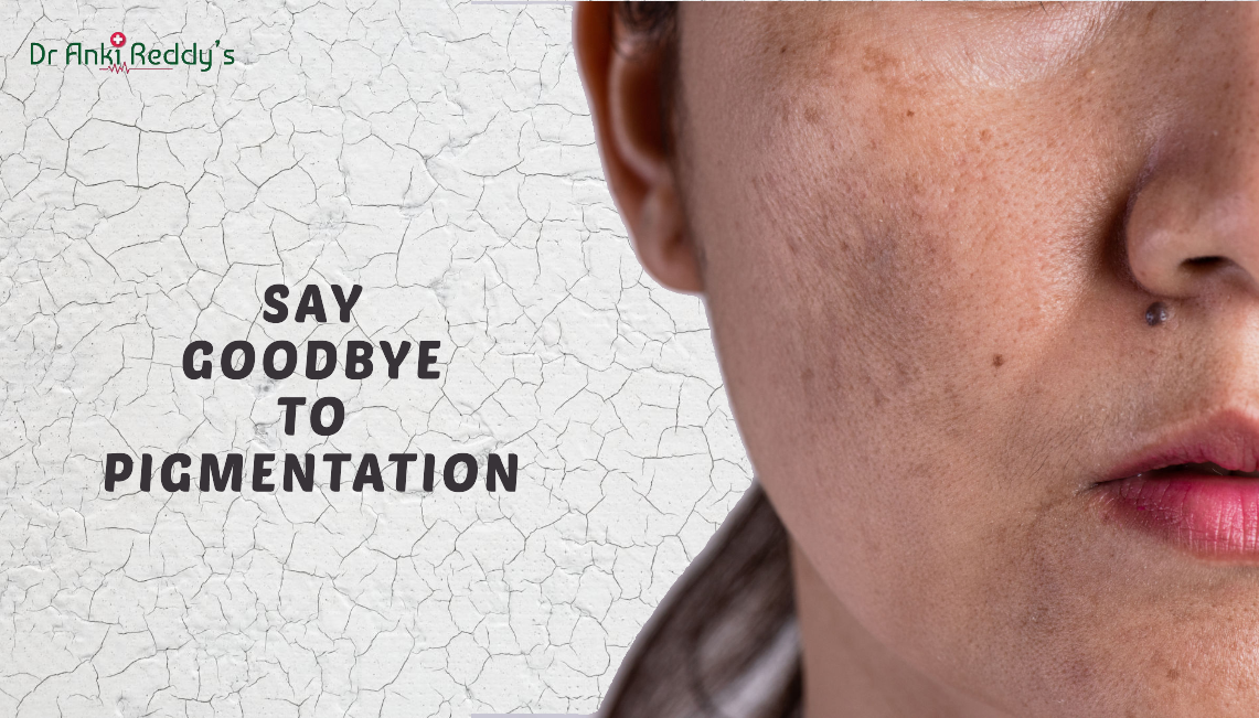 Pigmentation Removal Treatments