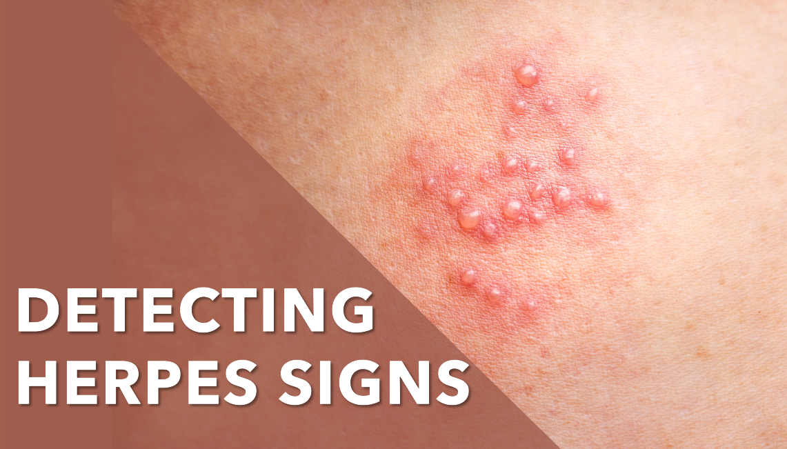 How to Spot Herpes Symptoms and Seek Proper Treatment