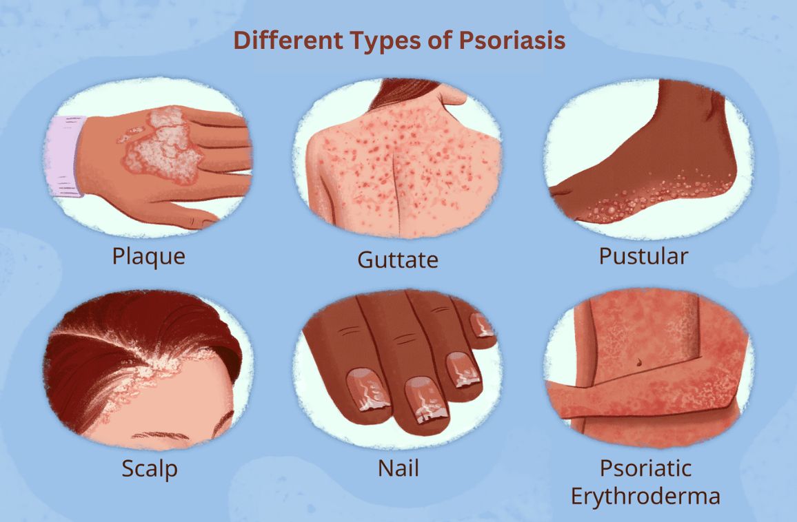 Different Types of Psoriasis and Their Symptoms