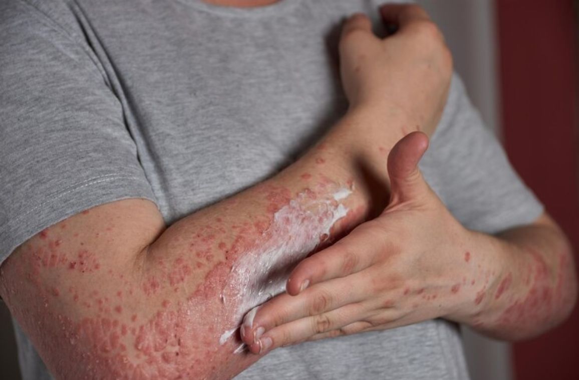 Different Types of Psoriasis and Their Symptoms