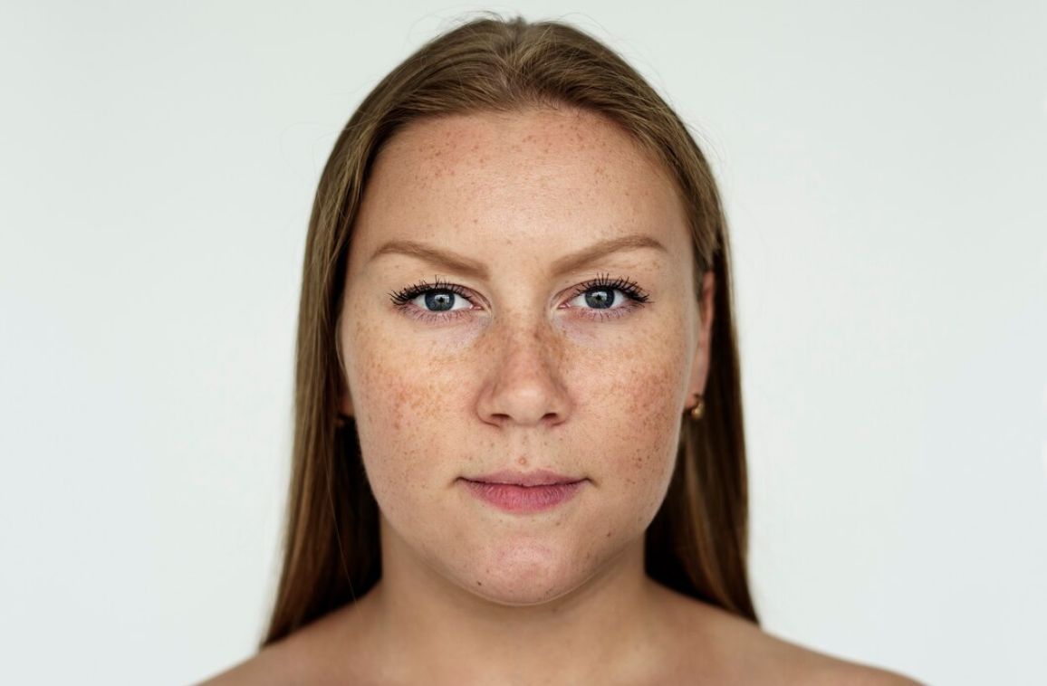 Melasma on Face: Causes, Treatments, and Prevention